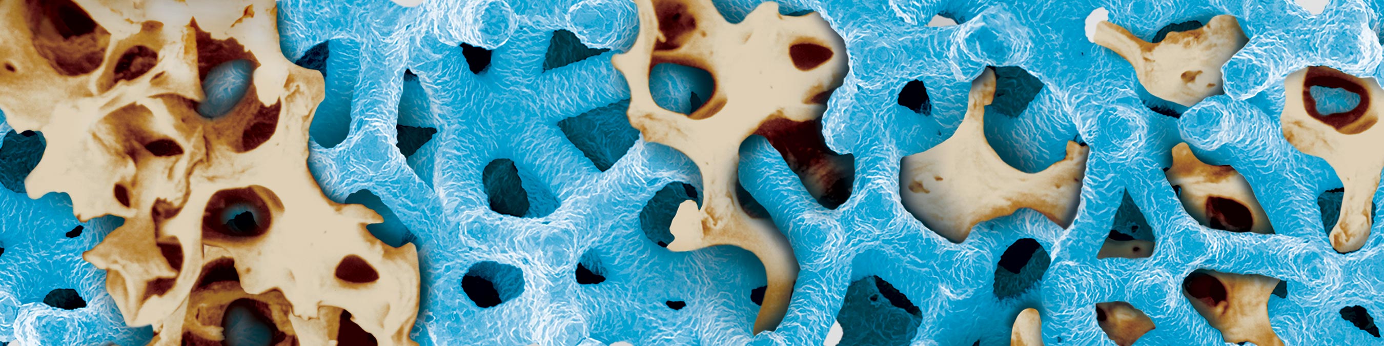 Trabecular Metal™ Technology | Zimmer Biomet