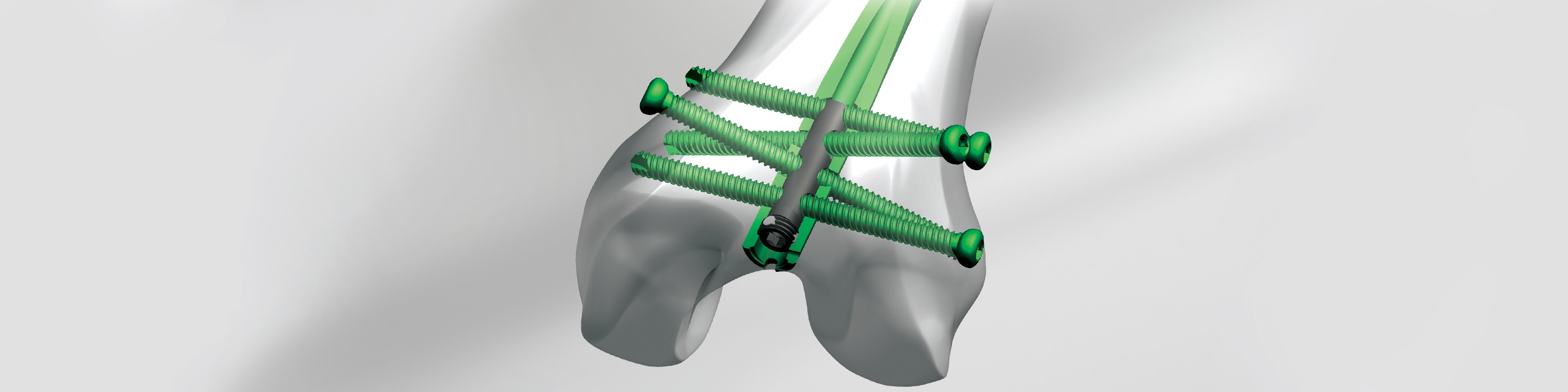 Comparative endurance testing of the Biomet Matthews Nail and the Dynamic  Compression Screw, in simulated condylar and supracondylar femoral  fractures | BioMedical Engineering OnLine | Full Text