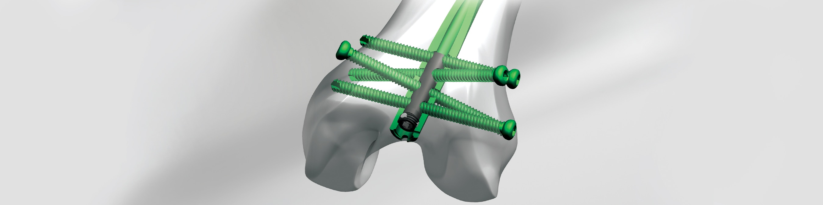 Retrograde Femoral Intramedullary Nail Extraction Techniques. Report of  Three Cases