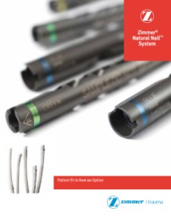Biomet Peritrochanteric Nail (PTN) System. Surgical Technique - PDF Free  Download