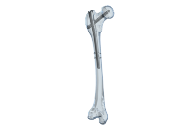 PhoenixÃ¢Â„Â¢ Retrograde Femoral Nail System - Biomet